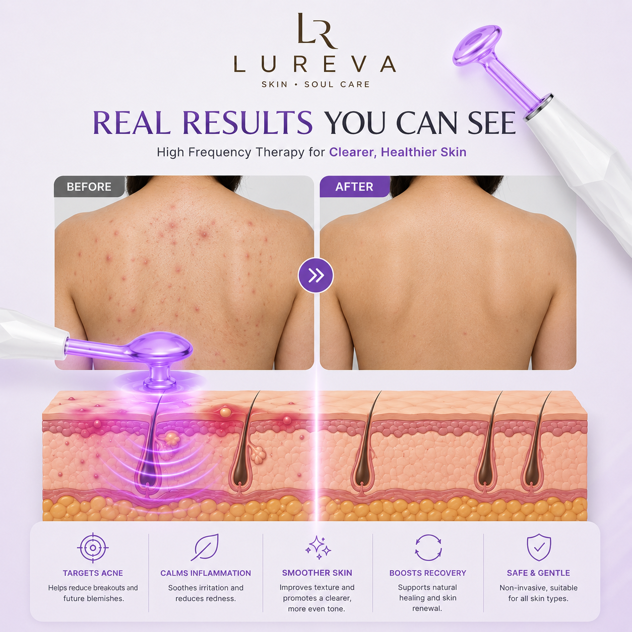 Lureva™ High Frequency Wand